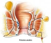 fistule anale